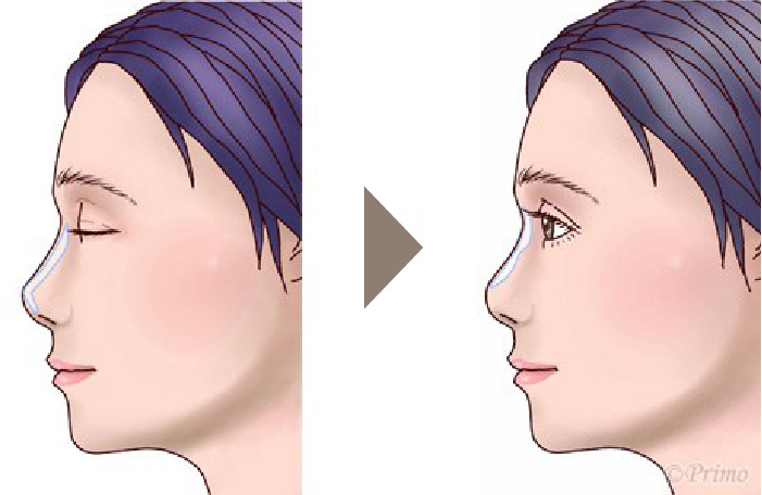 鼻プロテーゼ入れ替え術