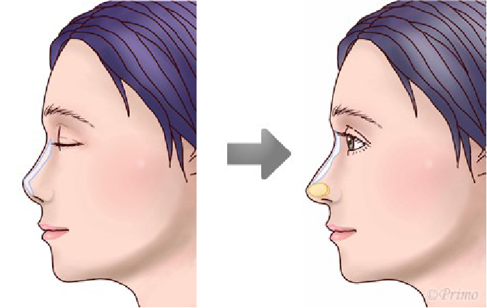 鼻プロテーゼ入れ替え術