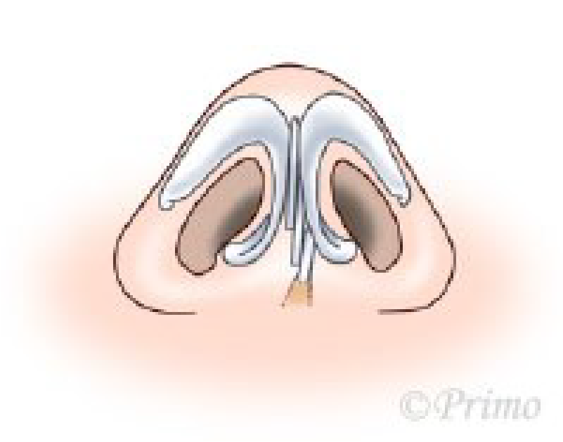 鼻中隔矯正術方法