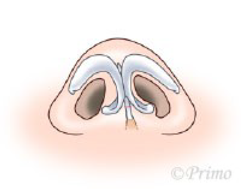 鼻中隔矯正術方法