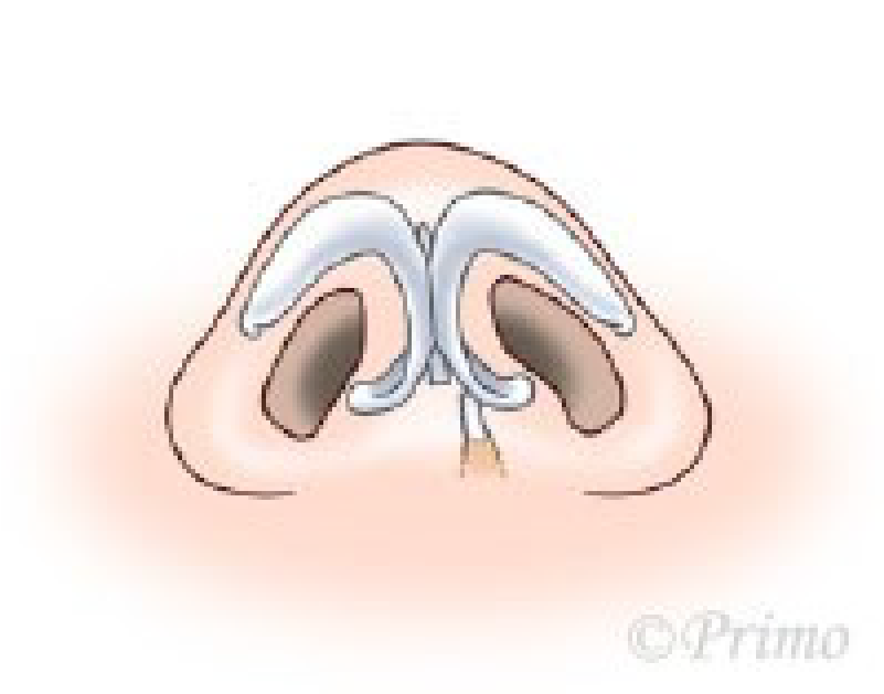 鼻中隔矯正術方法