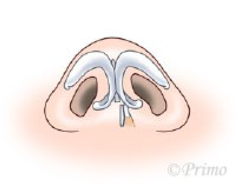 鼻中隔矯正術方法