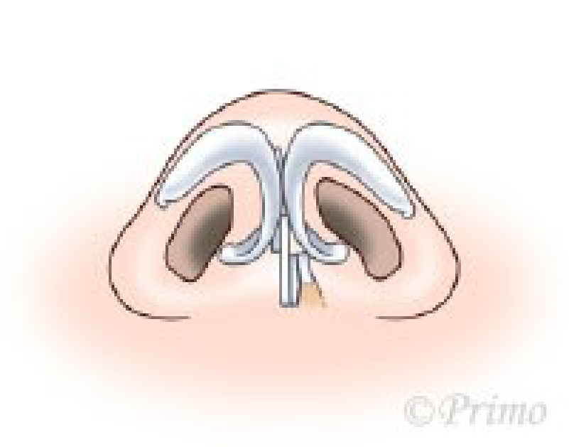 鼻中隔矯正術方法
