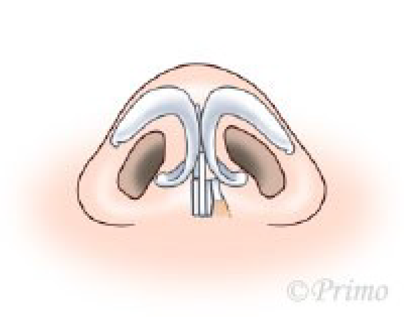 鼻中隔矯正術方法