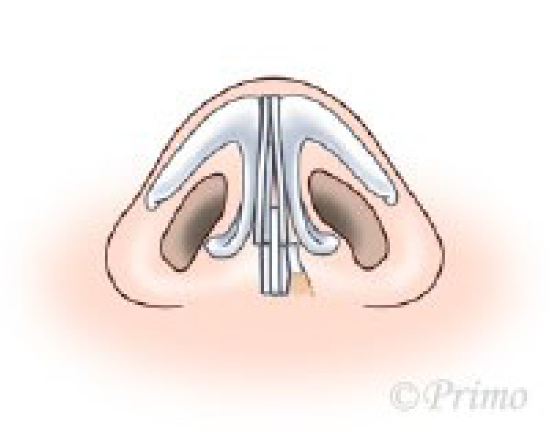 鼻中隔矯正術方法