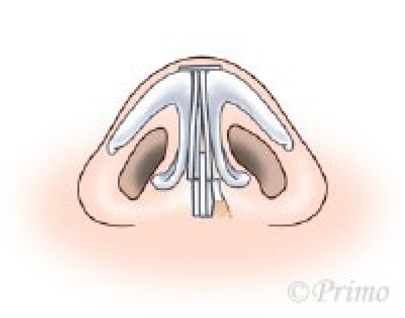 鼻中隔矯正術方法