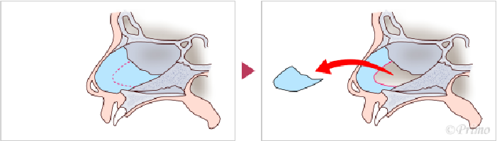 鼻中隔矯正術方法