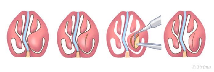 鼻中隔矯正術方法