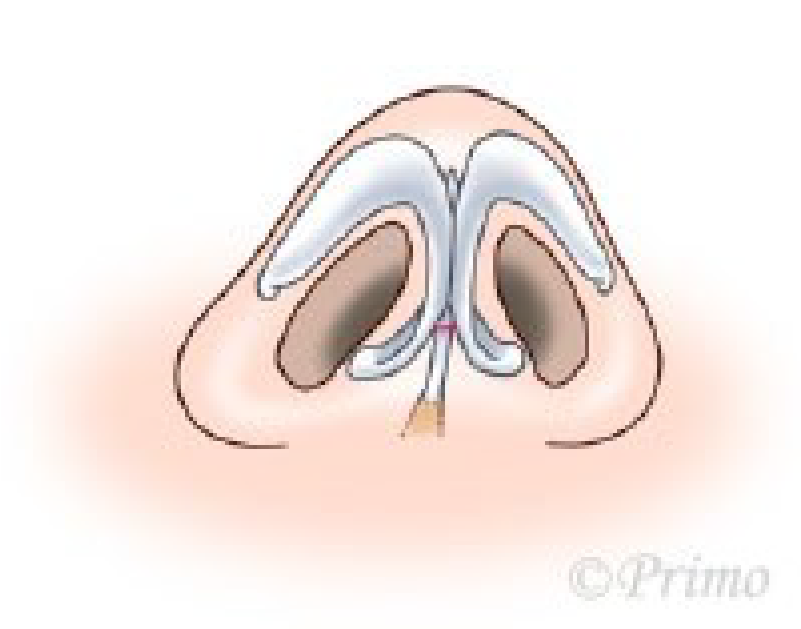 鼻中隔矯正術方法