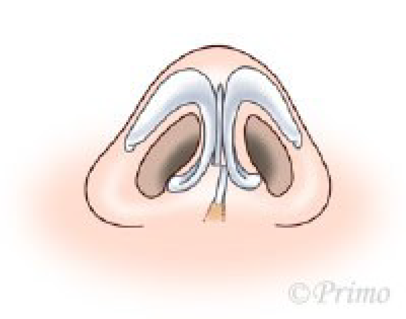 鼻中隔矯正術方法