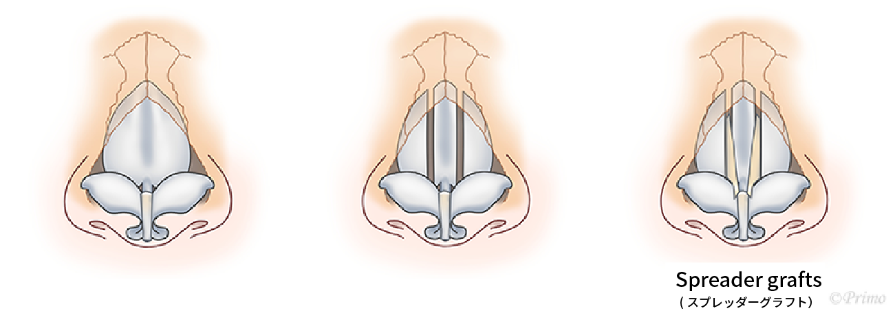 斜鼻の修正について