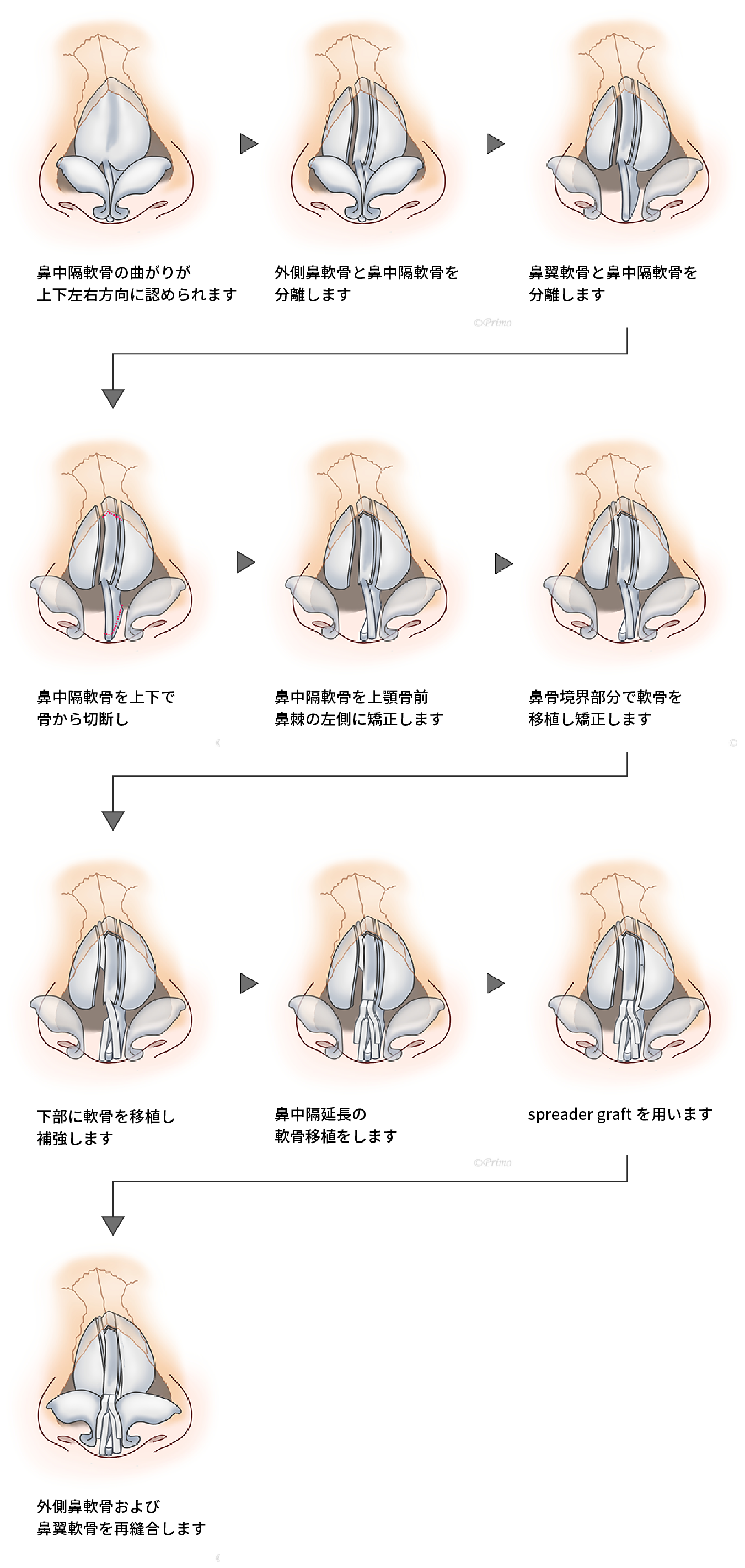 斜鼻の修正について