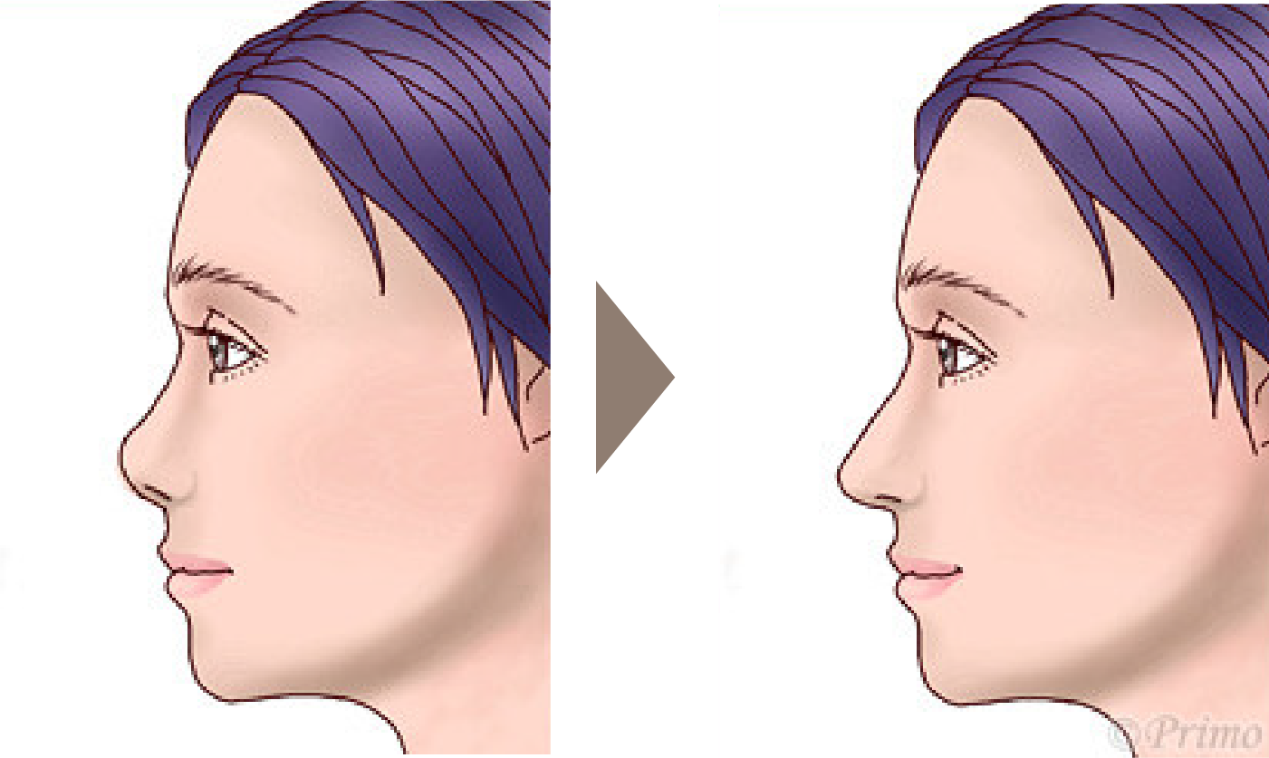 施術前後の横顔