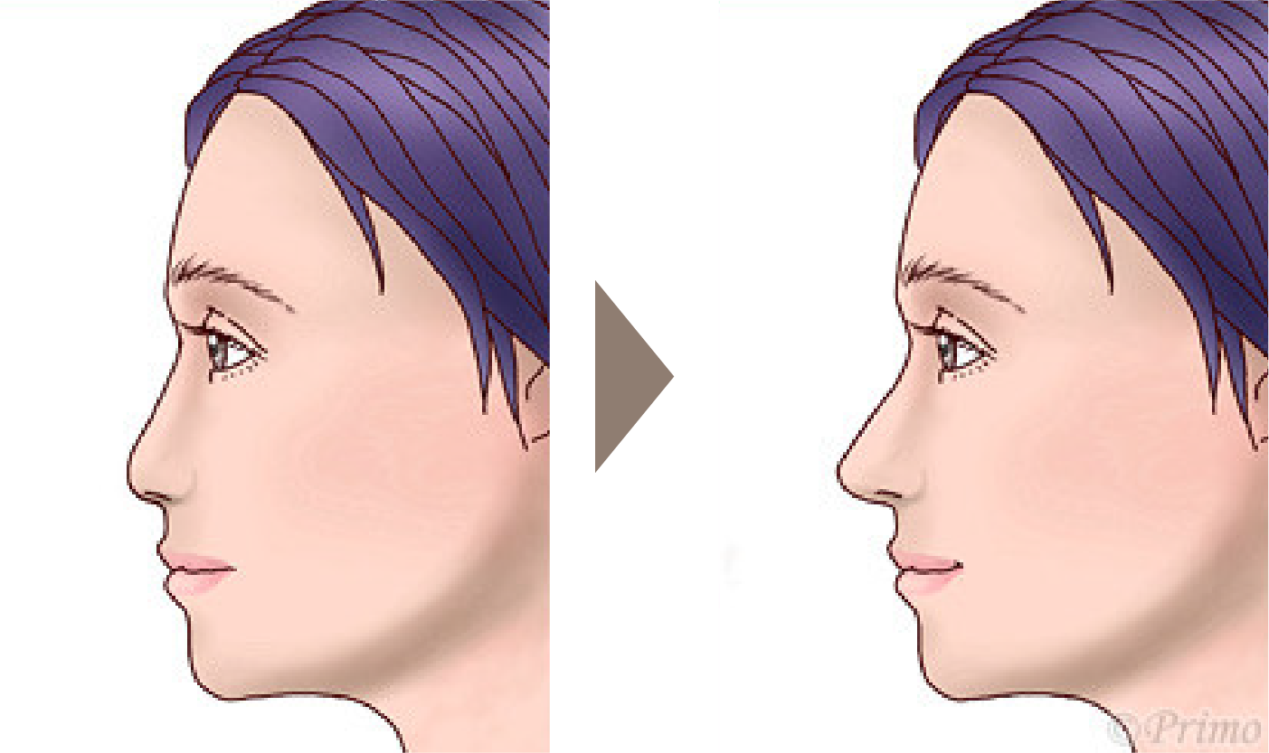 施術前後の横顔