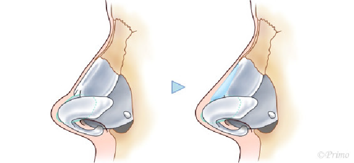 鼻中隔延長術のイメージ