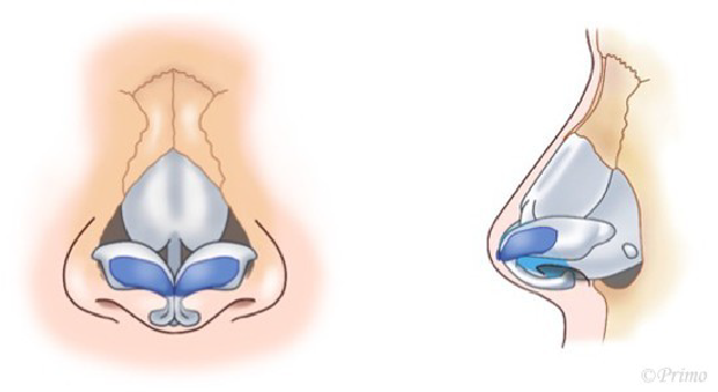 鼻中隔延長術の工程イメージ