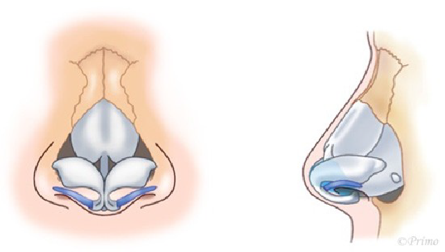 鼻中隔延長術の工程イメージ