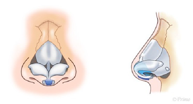 鼻中隔延長術の工程イメージ