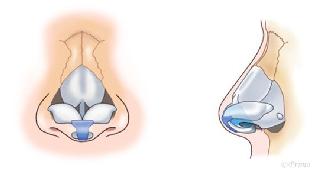 鼻中隔延長術の工程イメージ