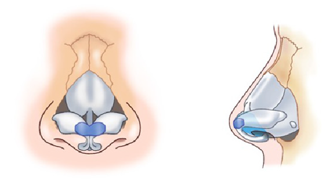 鼻中隔延長術の工程イメージ