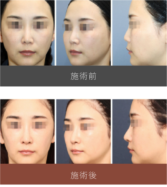施術前後の比較