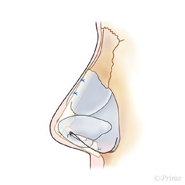 鼻中隔延長術の修正イメージ