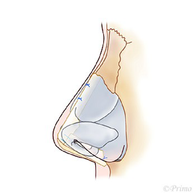 鼻中隔延長術の修正イメージ