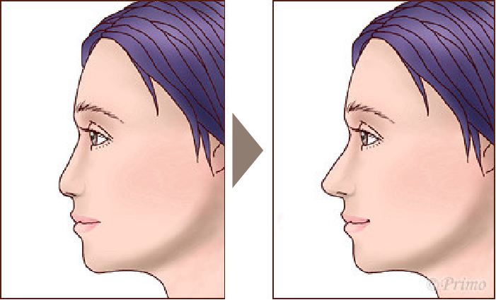 施術前後イメージ