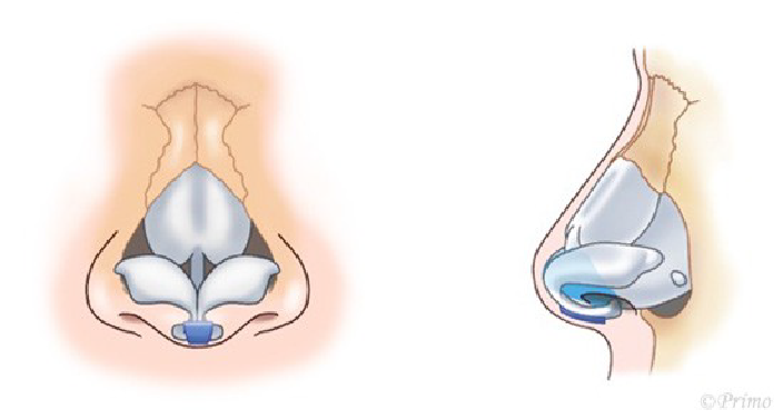 鼻尖形成術のイメージ