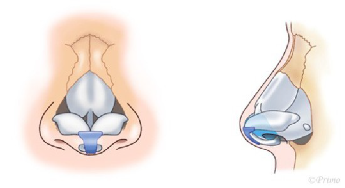 鼻尖形成術のイメージ