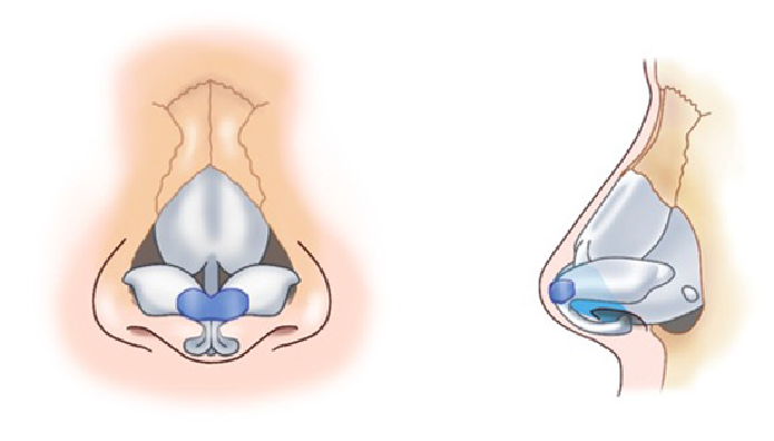 鼻尖形成術のイメージ