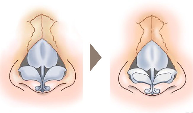 鼻尖形成術のイメージ