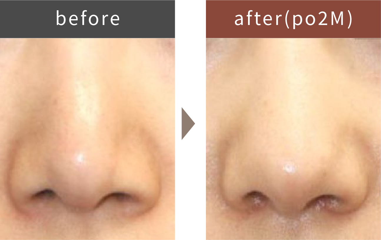 鼻尖形成術のイメージ