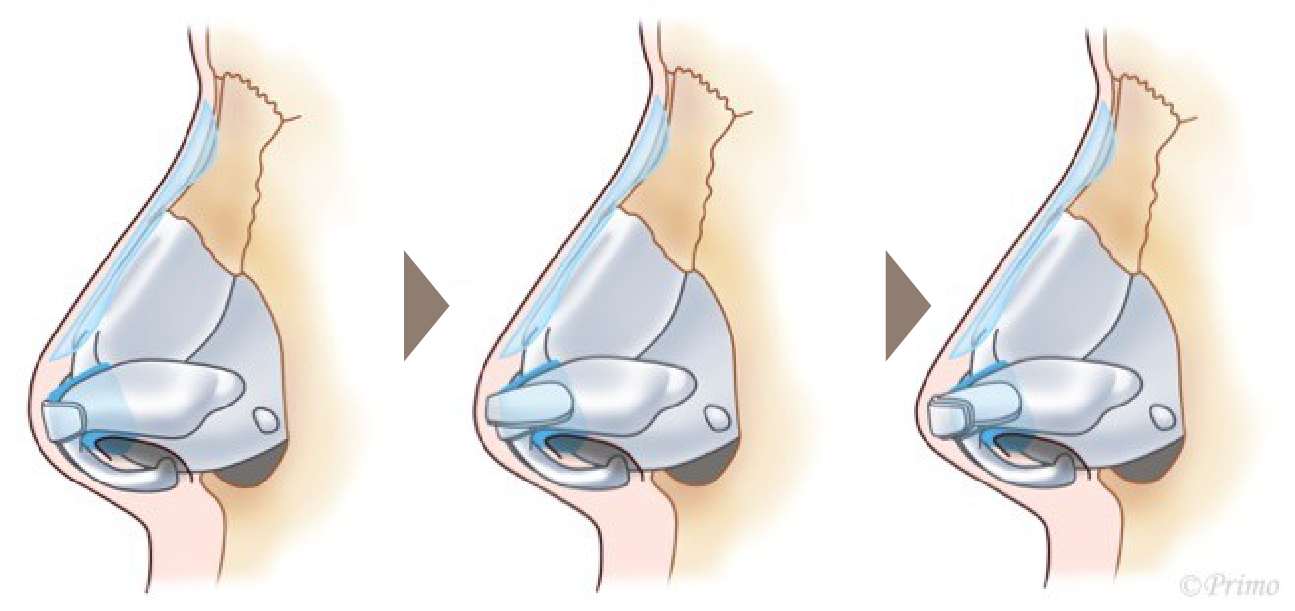 鼻尖形成術のイメージ