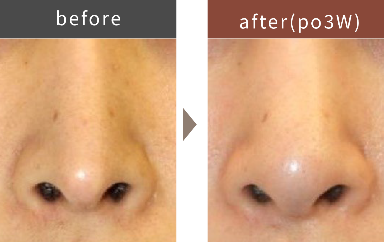 鼻尖形成術のイメージ