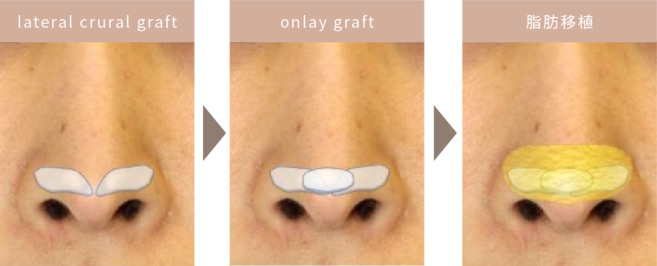 鼻尖形成術のイメージ