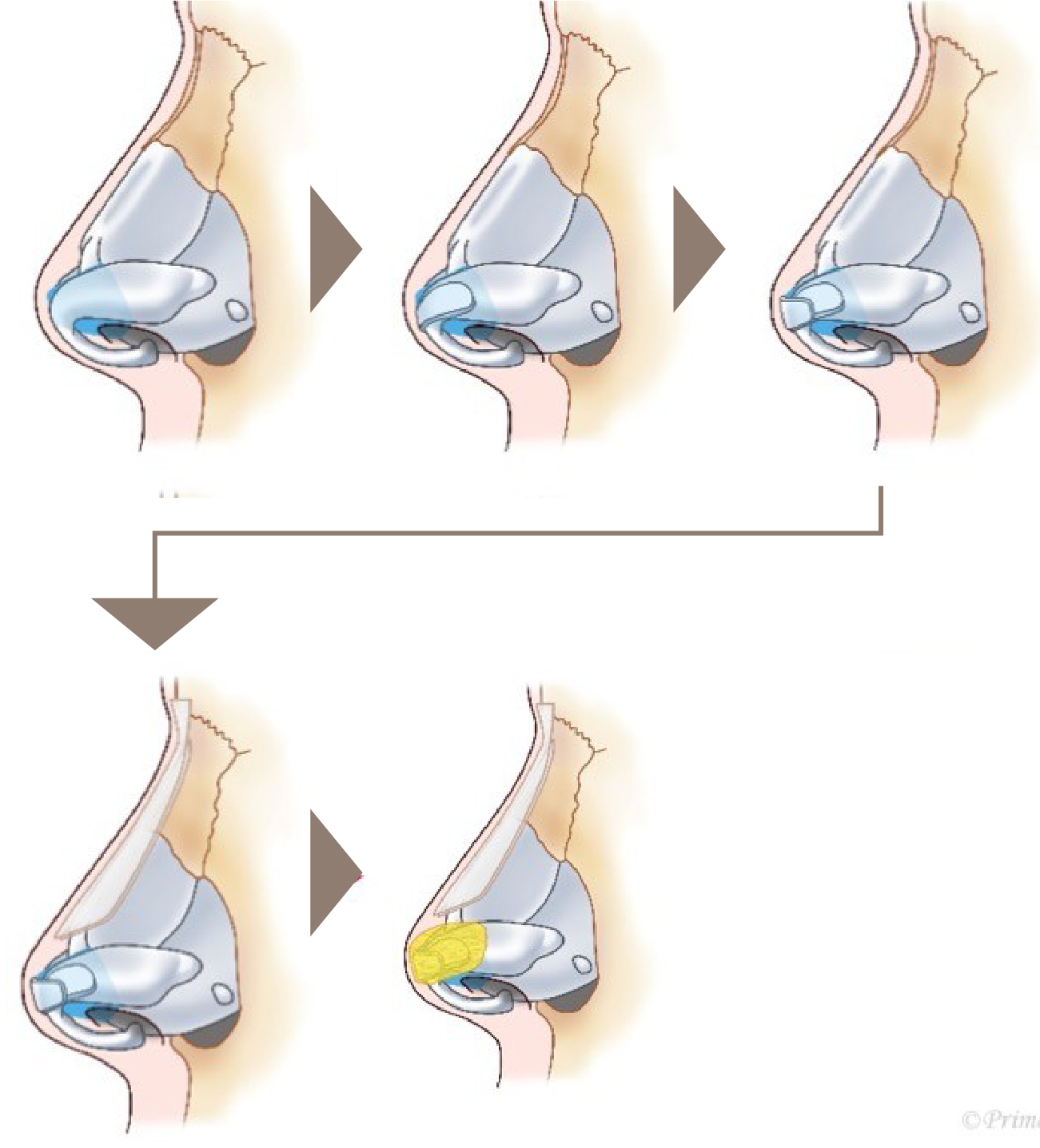 鼻尖形成術のイメージ