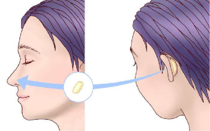 鼻尖形成術の方法解説画像