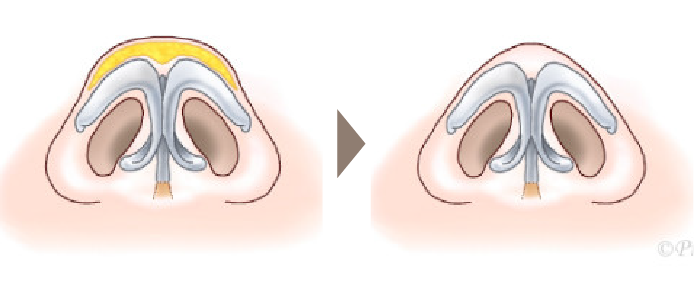 鼻尖形成術の方法解説画像
