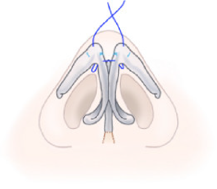 鼻尖形成術の方法解説画像