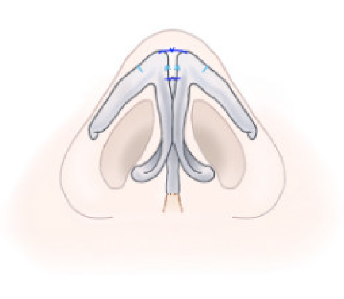 鼻尖形成術の方法解説画像