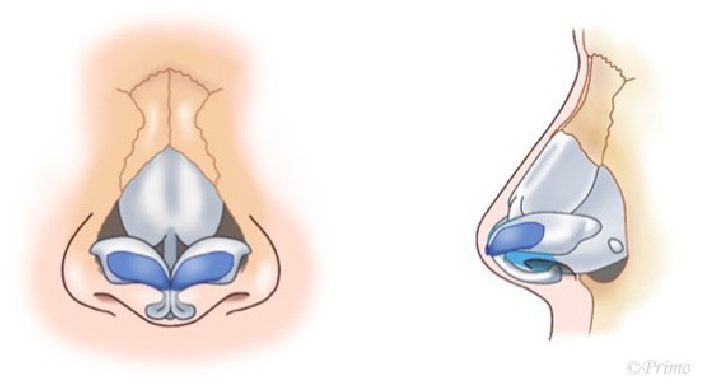鼻尖形成術のイメージ