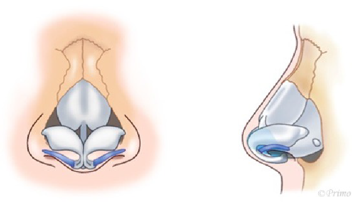 鼻尖形成術のイメージ