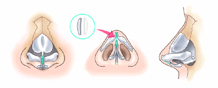 鼻尖縮小術3D法の方法