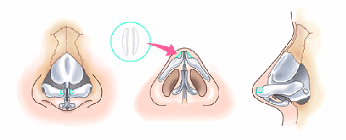 鼻尖縮小術3D法の方法
