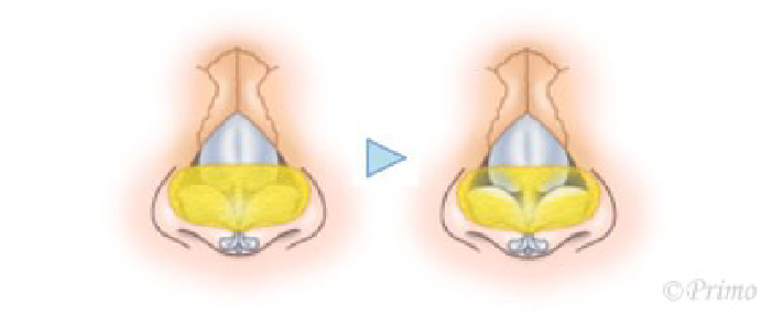 鼻尖縮小術3D法の方法