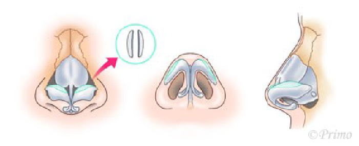 鼻尖縮小術3D法の方法