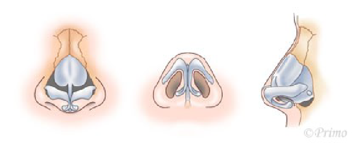 鼻尖縮小術3D法の方法