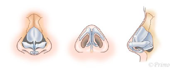 鼻尖縮小術3D法の方法