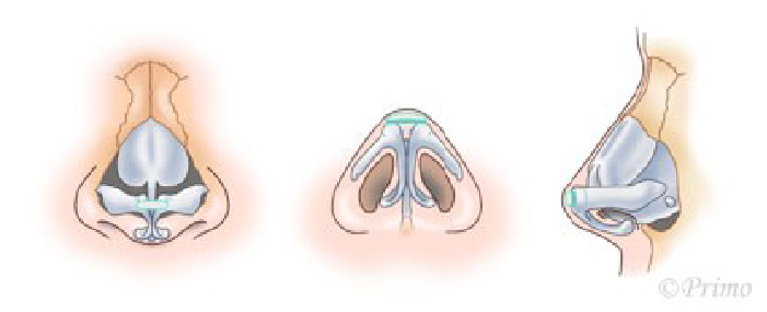 鼻尖縮小術3D法の方法